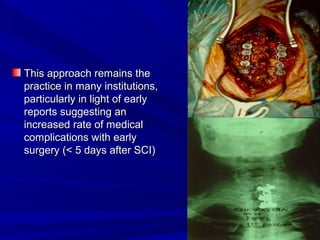 This aapppprrooaacchh rreemmaaiinnss tthhee 
pprraaccttiiccee iinn mmaannyy iinnssttiittuuttiioonnss,, 
ppaarrttiiccuullaarrllyy iinn lliigghhtt ooff eeaarrllyy 
rreeppoorrttss ssuuggggeessttiinngg aann 
iinnccrreeaasseedd rraattee ooff mmeeddiiccaall 
ccoommpplliiccaattiioonnss wwiitthh eeaarrllyy 
ssuurrggeerryy ((<< 55 ddaayyss aafftteerr SSCCII)) 
 