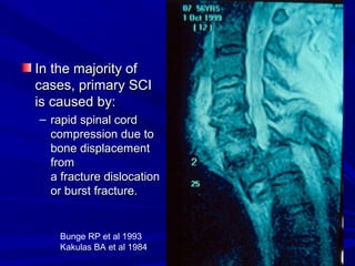 IInn tthhee mmaajjoorriittyy ooff 
ccaasseess,, pprriimmaarryy SSCCII 
iiss ccaauusseedd bbyy:: 
– rraappiidd ssppiinnaall ccoorrdd 
ccoommpprreessssiioonn dduuee ttoo 
bboonnee ddiissppllaacceemmeenntt 
ffrroomm 
aa ffrraaccttuurree ddiissllooccaattiioonn 
oorr bbuurrsstt ffrraaccttuurree.. 
Bunge RP et al 1993 
Kakulas BA et al 1984 
 