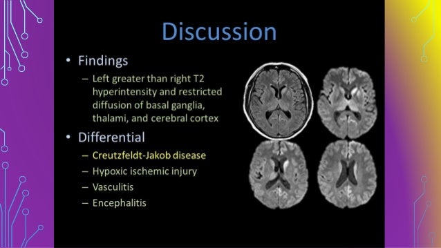 What are the symptoms of Creutzfeldt-Jakob disease?