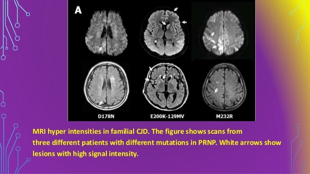Get Creutzfeldt-Jakob Disease Pictures Pics
