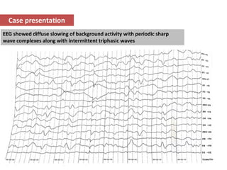 Creutzfeldt Jakob Disease Eeg