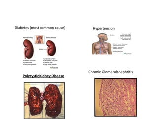Diabetes (most common cause)      Hypertension




                                Chronic Glomerulonephritis
    Polycystic Kidney Disease
 