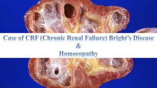 Renal Failure (Bright's Disease) & Homoeopathy (गुर्दा के खराब होने का होम्योपैथी उपचार)