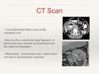 CT Scan
Circumferential bulky mass in the
intestinal wall
May involve a relatively long Segment of
bowel and may ulcerate and perforate into
the adjacent mesentery
Obstruction uncommon, since tumor does
not elicit a desmoplastic response
 