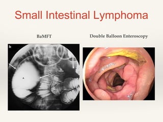 Small Intestinal Lymphoma
BaMFT Double Balloon Enteroscopy
 