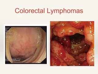 Colorectal Lymphomas
 