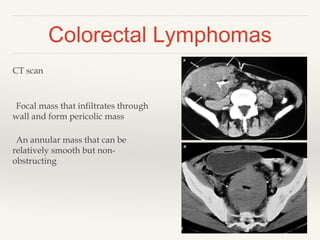 Colorectal Lymphomas
CT scan
Focal mass that infiltrates through
wall and form pericolic mass
An annular mass that can be
relatively smooth but non-
obstructing
 