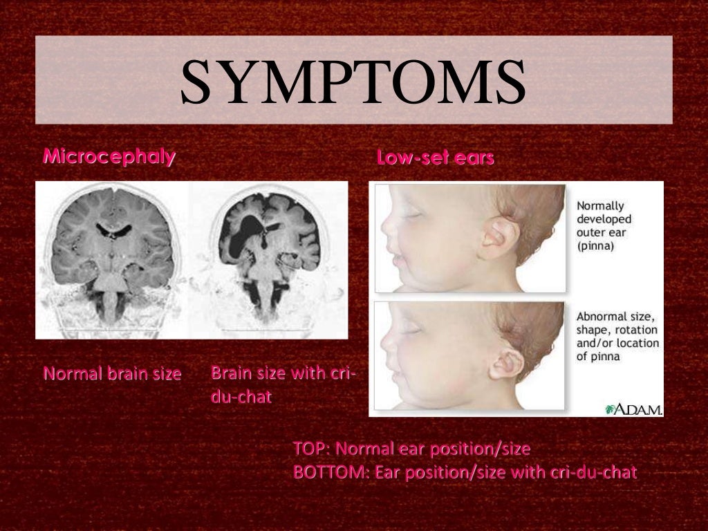 cri du chat syndrome cri du chat syndrome