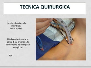 TECNICA QUIRURGICA
72h
Incision directa en la
membrana
cricotiroidea
El tubo debe insertarse
solo a 1 o 2 cm mas alla
del extremo del manguito
con globo
 