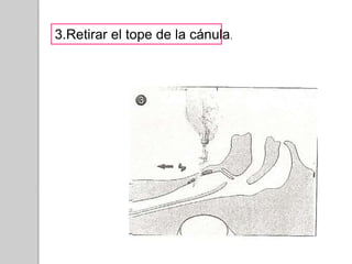 3.Retirar el tope de la cánula. 
 