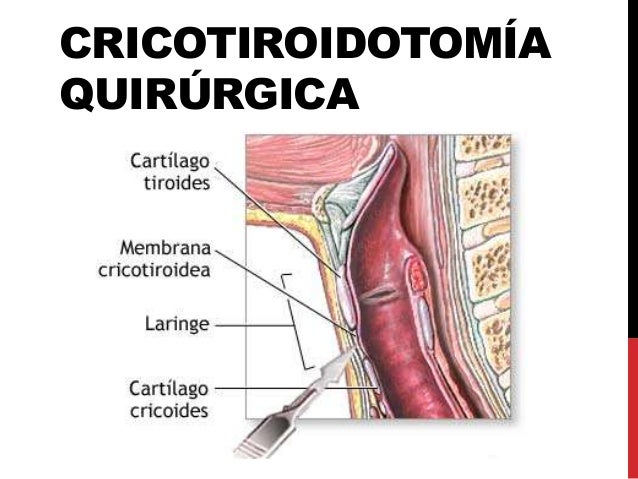 Cricotiroidotomía quirúrgica