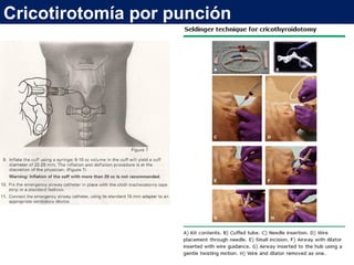 Cricotirotomía por punción
 
