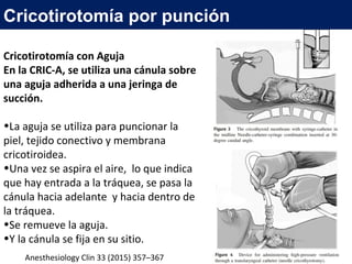 Cricotirotomía por punción
Cricotirotomía con Aguja
En la CRIC-A, se utiliza una cánula sobre
una aguja adherida a una jeringa de
succión.
•La aguja se utiliza para puncionar la
piel, tejido conectivo y membrana
cricotiroidea.
•Una vez se aspira el aire, lo que indica
que hay entrada a la tráquea, se pasa la
cánula hacia adelante y hacia dentro de
la tráquea.
•Se remueve la aguja.
•Y la cánula se fija en su sitio.
Anesthesiology Clin 33 (2015) 357–367
 