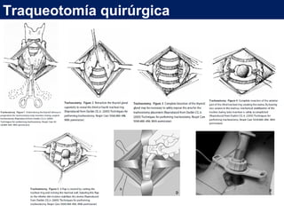 Traqueotomía quirúrgica
 