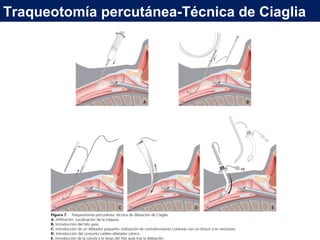 Traqueotomía percutánea-Técnica de Ciaglia
 