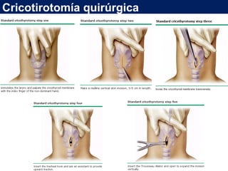 Cricotirotomía quirúrgica
 