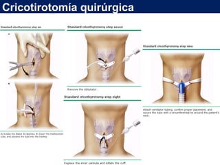 Cricotirotomía quirúrgica
 