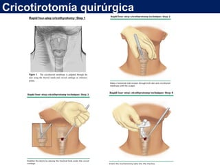 Cricotirotomía quirúrgica
Rapid four-step cricothyrotomy: Step 1
 