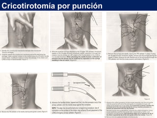 Cricotirotomía por punción
 