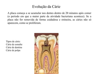 Evolução da Cárie
A placa começa a se acumular nos dentes dentro de 20 minutos após comer
(o período em que a maior parte da atividade bacteriana acontece). Se a
placa não for removida de forma cuidadosa e rotineira, as cáries não só
aparecem, como se proliferam.

Tipos de cárie:
Cárie de esmalte
Cárie de dentina
Cárie de polpa

 