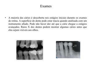 Exames
• A maioria das cáries é descoberta nos estágios iniciais durante os exames
de rotina. A superfície do dente pode estar macia quando analisada com um
instrumento afiado. Pode não haver dor até que a cárie chegue a estágios
avançados. Raios X dos dentes podem mostrar algumas cáries antes que
elas sejam visíveis aos olhos.

 