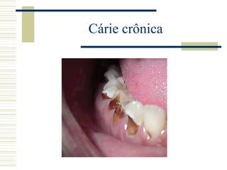 Cárie crônica
 
