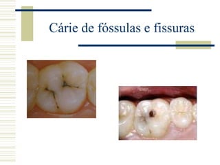 Cárie de fóssulas e fissuras
 