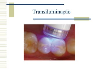 Transiluminação
 