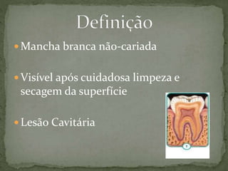 Mancha branca não-cariada 
 Visível após cuidadosa limpeza e 
secagem da superfície 
Lesão Cavitária 
 