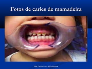 Fotos de caries de mamadeira

Slide Elaborado por ASB Andressa

 