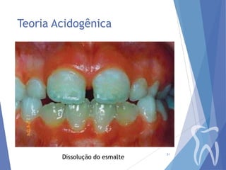 Teoria Acidogênica

Dissolução do esmalte

21

 