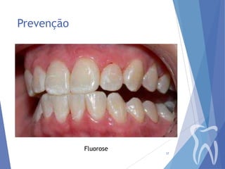 Prevenção

Fluorose

37

 