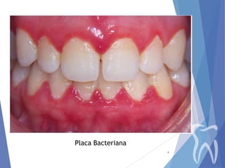 Placa Bacteriana
9

 
