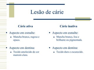 Lesão de cárie

           Cárie ativa                     Cárie inativa

 Aspecto em esmalte:             Aspecto em esmalte:
      Mancha branca, rugosa e         Mancha branca, lisa e
       opaca.                           brilhante ou pigmentada.


 Aspecto em dentina:             Aspecto em dentina:
      Tecido amolecido de cor         Tecido duro e escurecido.
       marrom clara.
 
