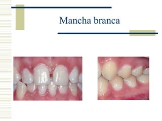 Mancha branca
 
