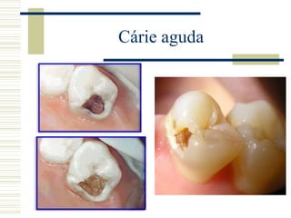 Cárie aguda
 