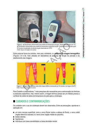 D
EG
U
STAÇ
ÃO
BA
Figura 2 – A) Termômetro infravermelho para análise da temperatura da água. Temperatura da água em 1ºC.
B) Termômetro infravermelho para análise da temperatura superficial da pele. Temperatura do tornozelo após
20 minutos de aplicação do pacote de gelo observada em 5,5ºC.
Fonte:	Arquivo de imagens dos autores.
Outra possível forma de controle, mais cara, entretanto, é a máquina de imagem termográfica
(Figuras 3 A e B), mais utilizada em laboratórios de pesquisa em função da precisão e do
detalhamento das imagens.
Figura 3 – Imagens termográficas antes (A) e depois (B) da crioimersão por 20 minutos, com água a 6±2ºC.
Fonte:	Arquivo de imagens dos autores.
Para Costello e colaboradores,78
mais pesquisas são necessárias para a estruturação de diretrizes
e protocolos específicos, mas, mesmo assim, a imagem térmica parece ser um método preciso e
confiável de coleta de dados de temperatura da pele após a crioterapia.
■■ CUIDADOS E CONTRAINDICAÇÕES
Os cuidados com o uso da crioterapia devem ser observados. Entre as precauções, aponta-se a
aplicação em:
■■ um ramo nervoso superficial, como o nervo fibular (sobre a cabeça da fíbula), o nervo radial
(região lateral do cotovelo) e o nervo ulnar (região medial do cotovelo);
■■ lesões abertas;
■■ hipertensos;
■■ indivíduos com baixa sensibilidade ou baixa atividade mental.
83
|PROFISIOESPORTIVAETRAUMATO-ORTOPÉDICA|Ciclo3|Volume1|
 