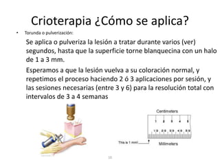Crioterapia ¿Cómo se aplica?
• Torunda o pulverización:
Se aplica o pulveriza la lesión a tratar durante varios (ver)
segundos, hasta que la superficie torne blanquecina con un halo
de 1 a 3 mm.
Esperamos a que la lesión vuelva a su coloración normal, y
repetimos el proceso haciendo 2 ó 3 aplicaciones por sesión, y
las sesiones necesarias (entre 3 y 6) para la resolución total con
intervalos de 3 a 4 semanas
10
 