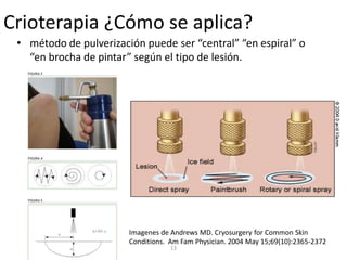 Crioterapia ¿Cómo se aplica?
• método de pulverización puede ser “central” “en espiral” o
“en brocha de pintar” según el tipo de lesión.
13
Imagenes de Andrews MD. Cryosurgery for Common Skin
Conditions. Am Fam Physician. 2004 May 15;69(10):2365-2372
 