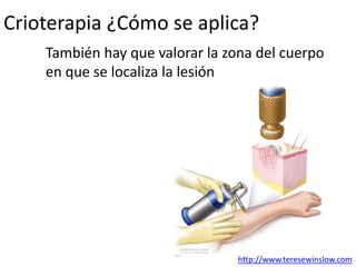 Crioterapia ¿Cómo se aplica?
También hay que valorar la zona del cuerpo
en que se localiza la lesión
17
http://www.teresewinslow.com
 