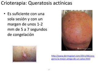 Crioterapia: Queratosis actínicas
• Es suficiente con una
sola sesión y con un
margen de unos 1-2
mm de 5 a 7 segundos
de congelación
27
http://www.dermapixel.com/2011/06/una-
gorra-la-mejor-amiga-de-un-calvo.html
 