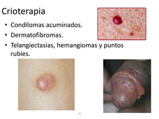 Crioterapia
• Condilomas acuminados.
• Dermatofibromas.
• Telangiectasias, hemangiomas y puntos
rubíes.
28
 