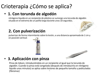 Crioterapia ¿Cómo se aplica?
• 1. Con torunda de algodón
nitrógeno líquido en un recipiente de plástico se sumerge una torunda de algodón
situada en el extremo de un palillo largo durante unos 10 segundos.
2. Con pulverización
pulverizar de forma intermitente sobre la lesión, a una distancia aproximada de 1 cm y
en posición vertical.
• 3. Aplicación con pinza
Pinza de Adson, introduciéndola en un recipiente al igual que la torunda de
algodón. Cuando la pinza está congelada (después de introducirla en nitrógeno
líquido unos minutos) se aplica sobre lesiones de pequeño tamaño y pediculadas
(fibromas) 9
 