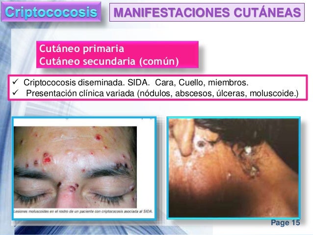 Criptococosis e Histoplasmosis.
