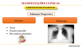 CRIPTOCOCOSE
MANIFESTAÇÕES CLINICAS
RadiologiaSintomas
 Tosse
 Escarro mucoide
 Dor torácica pleurítica
CRIPTOCOCOSE PULMONAR
Pulmonar Progressiva
 