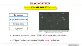 Leveduras
Cap. polissacarídica
Tinta da china
Nigrosina
 Amostras purulentas KOH a 10% eliminar células.
 O líquor e urina deve ser centrifugado sedimento
https://pt.wikipedia.org
CRIPTOCOCOSE
DIAGNÓSTICO
EXAME DIRETO
 