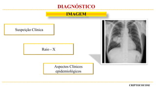 CRIPTOCOCOSE
DIAGNÓSTICO
IMAGEM
Suspeição Clínica
Raio - X
Aspectos Clínicos
epidemiológicos
 