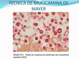TECNICA DE MUCICAMINA DE
MAYER

 