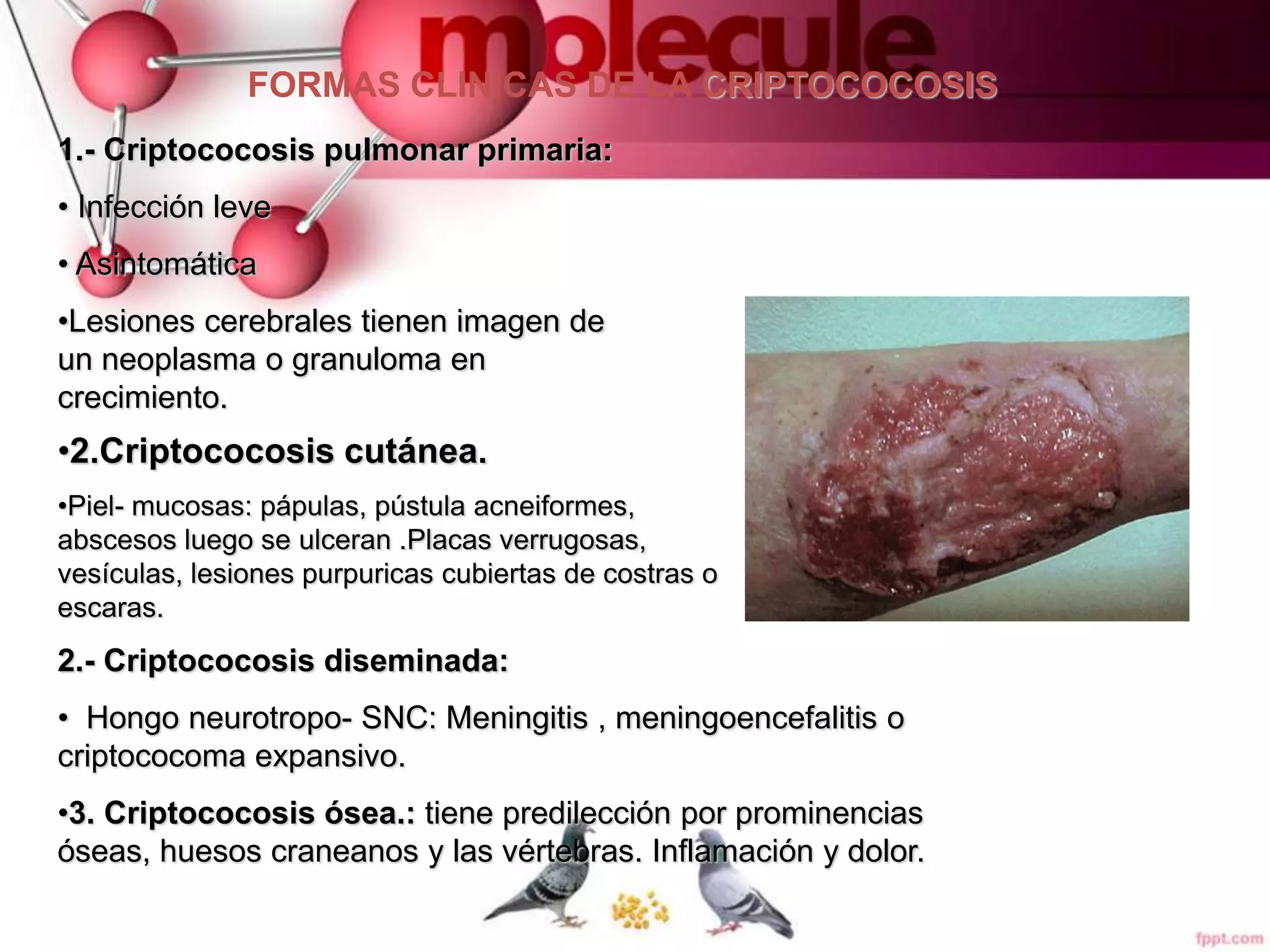 Criptococosis | PPT