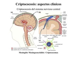 Criptococosis: aspectos clínicos
Criptococosis del sistema nervioso central
Meningitis/ Meningoencefalitis / Criptococomas
 